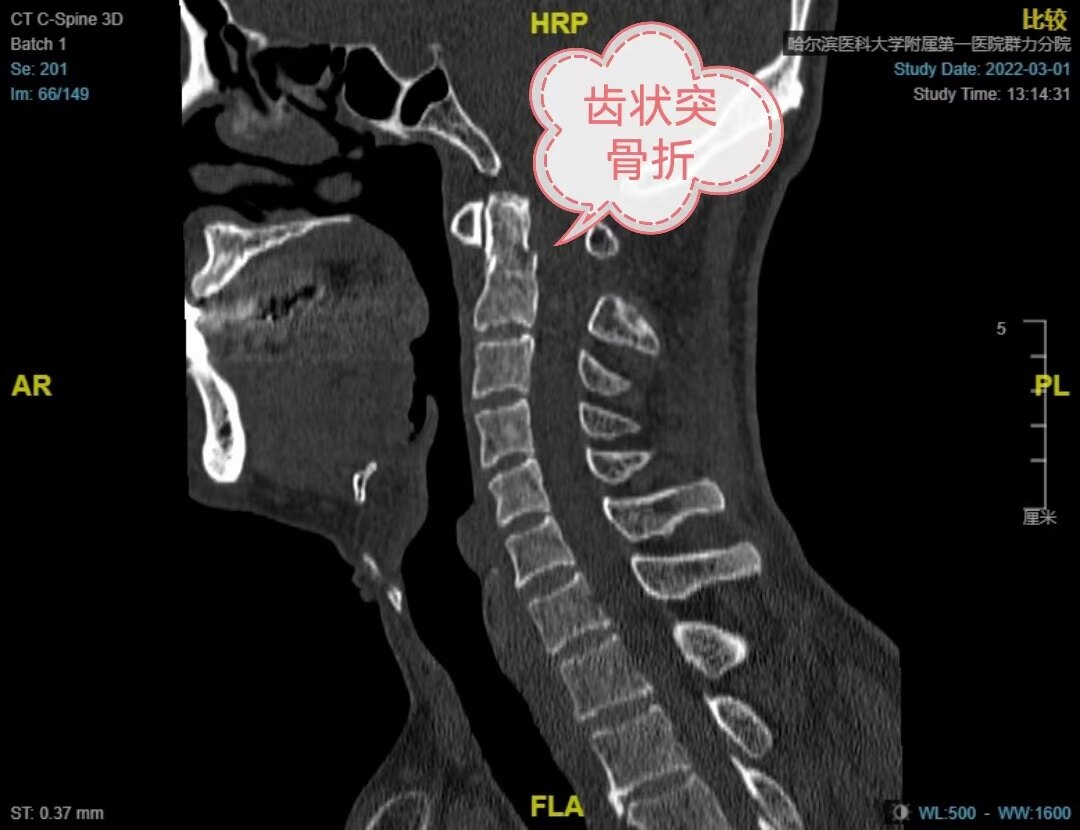 枢椎椎弓骨折图片