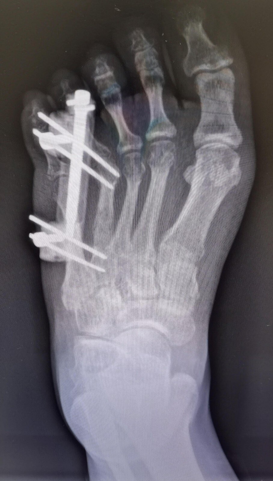 短趾症brachymetatarsia