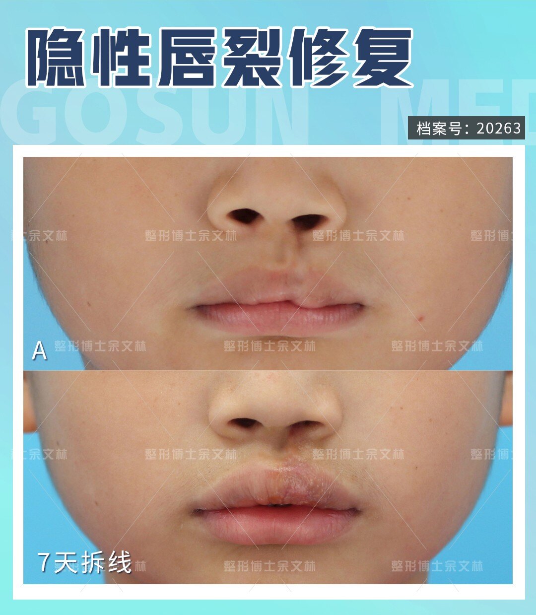 唇裂I期后遗留的各种畸形及唇裂II期疤痕畸形的修复 - 知乎