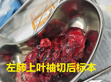 包括:左肺上叶袖切,左肺下叶袖切,右肺上叶袖切,右中叶袖切,左肺上叶