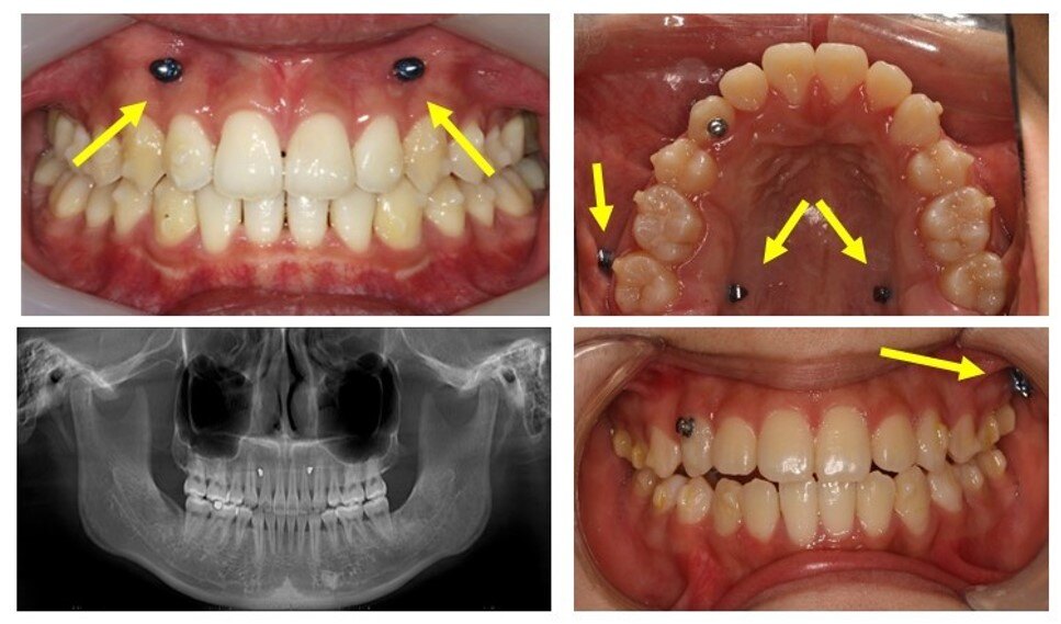 骨钉与正畸_正畸_正畸治疗方式 - 好大夫在线