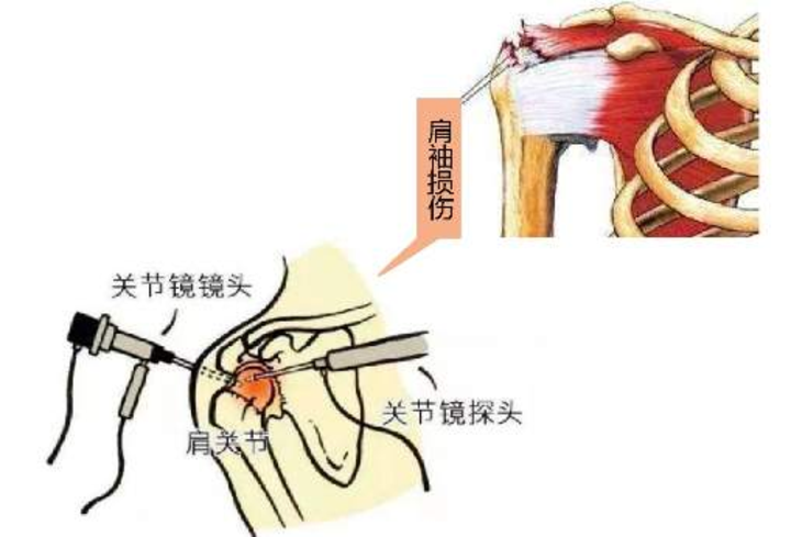 可進行針刀或局部封閉治療,或配合消炎止痛藥;若為肩袖損傷,更需及時