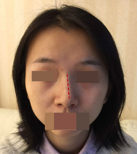 鼻梁歪斜不美观应该如何改善 好大夫在线