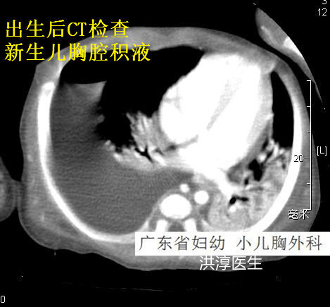 CT：胸腔积液128683-8-水印版.jpg