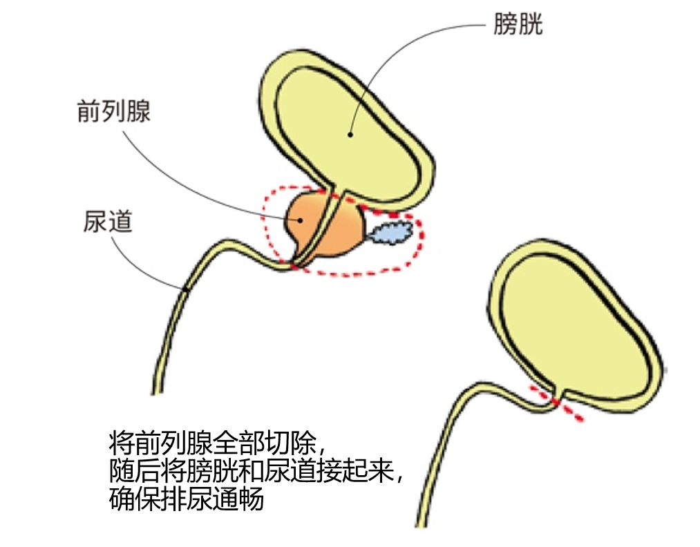 根治性手术的机会,而根治性手术需要把前列腺切除后再把膀胱与尿道