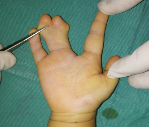 新生婴儿并指无植皮手术什么时候可以做?_多指畸形 - 好大夫在线