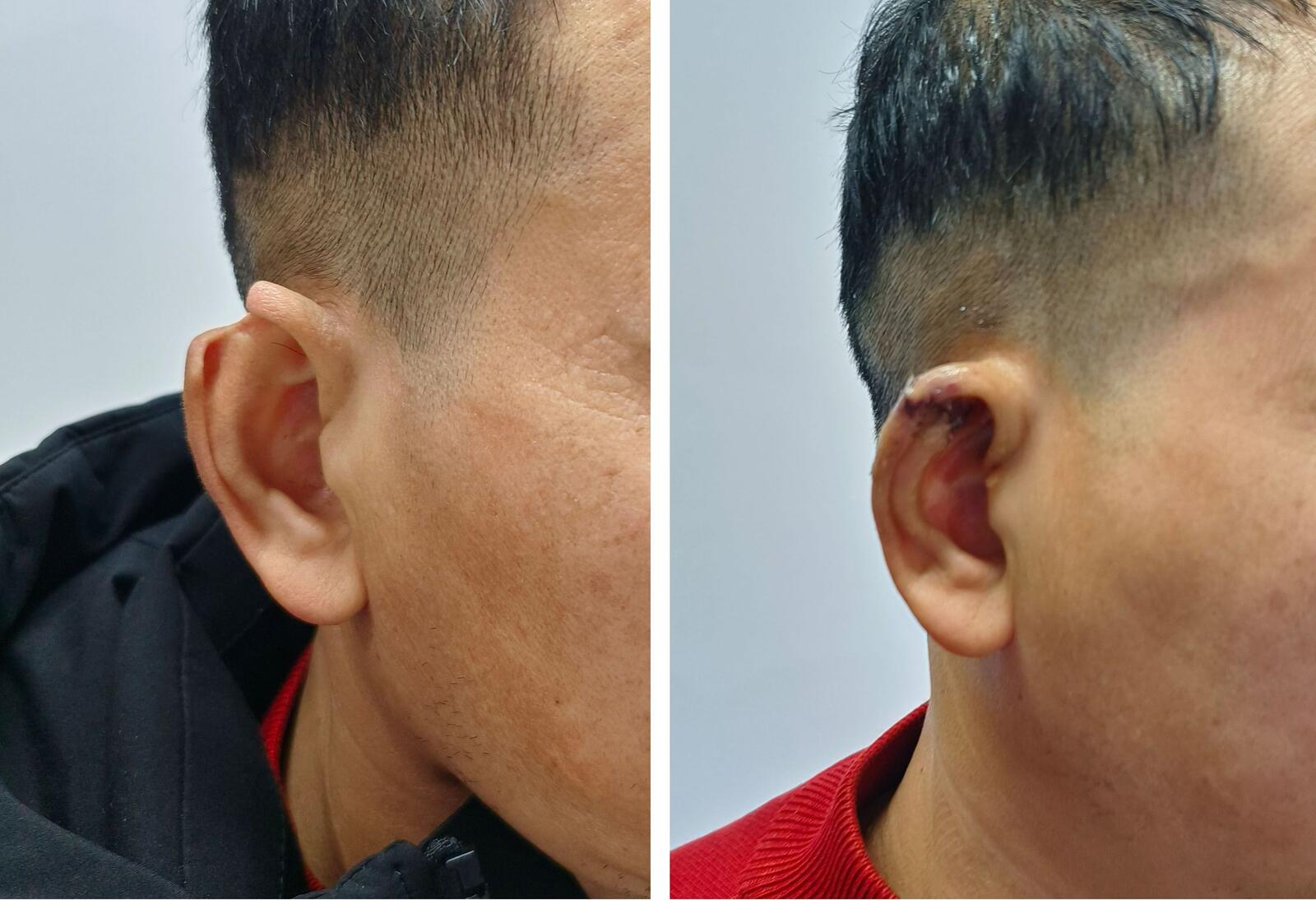 PRS：YAG 激光辅助耳廓矫正模型治疗先天性耳廓畸形成功有效-MedSci.cn