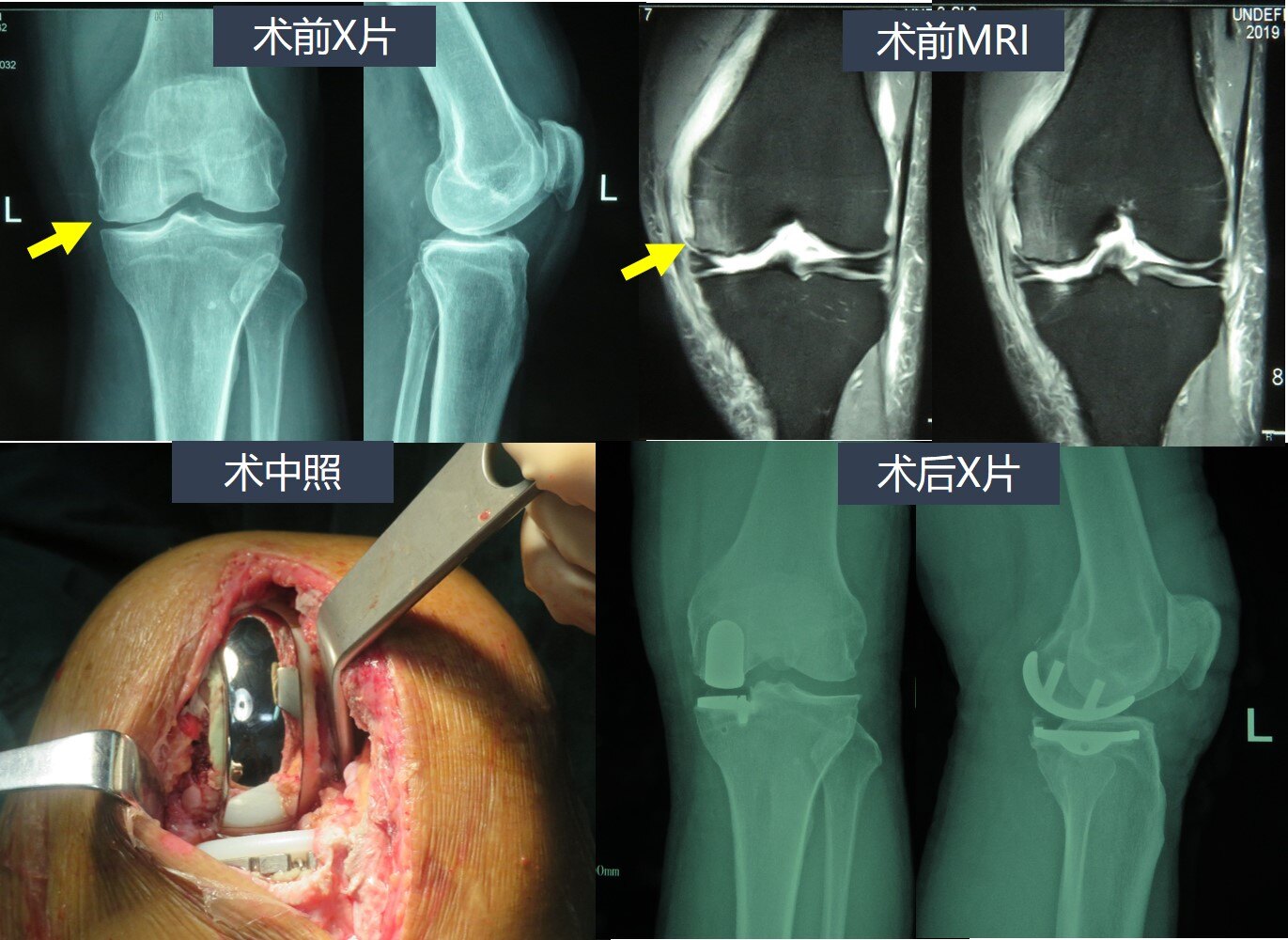 膝关节单髁置换术费用图片