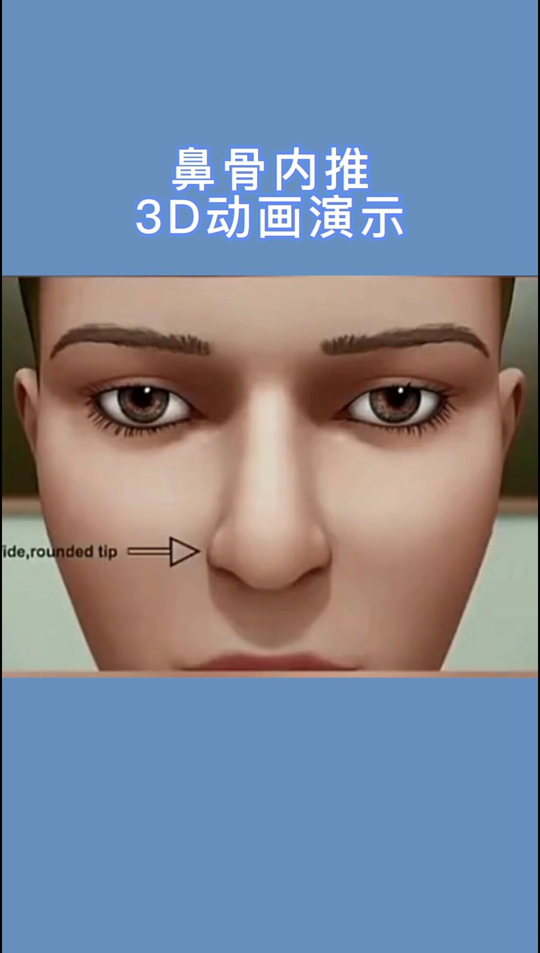 3d动画演示:告诉你"鼻骨内推"是怎么做的?_鼻部整形