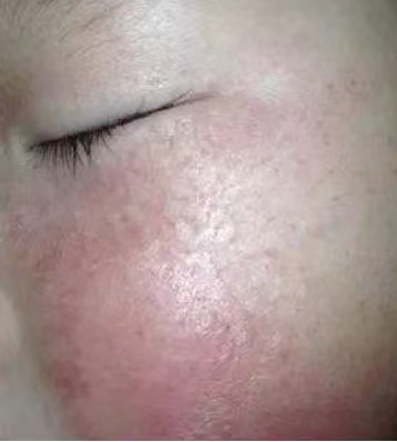 宝宝脸经常会皴 日常该如何护理呢 小儿湿疹 小儿湿疹日常注意事项 好大夫在线 宝宝脸经常会皴 日常该如何护理呢 小儿湿疹 小儿湿疹日常注意事项 好大夫在线