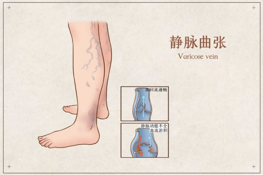 蚯蚓腿,是下肢静脉曲张的俗称之一,因皮肤血管走形像蚯蚓迂曲,便得此