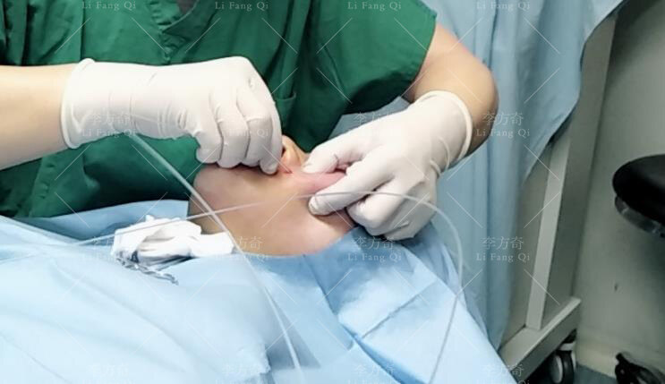 骨粉?硅油?生长因子?取出方式有何不同?