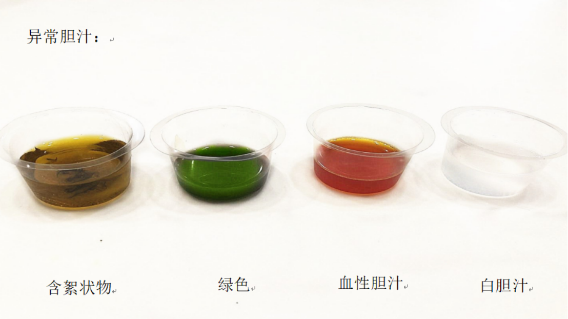 正确认识”T”管、居家护理T管,关爱带管患者_胆管结石_治疗方式_日常注意事项 - 好大夫在线
