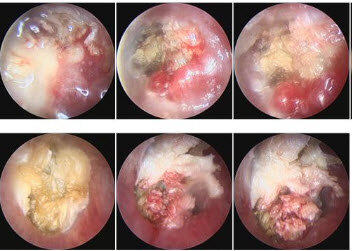 儿童外耳道胆脂瘤图片图片