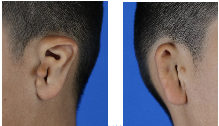 案例秀:先天性耳甲粘连畸形并外耳道闭锁_小耳畸形_介绍_检查_治疗