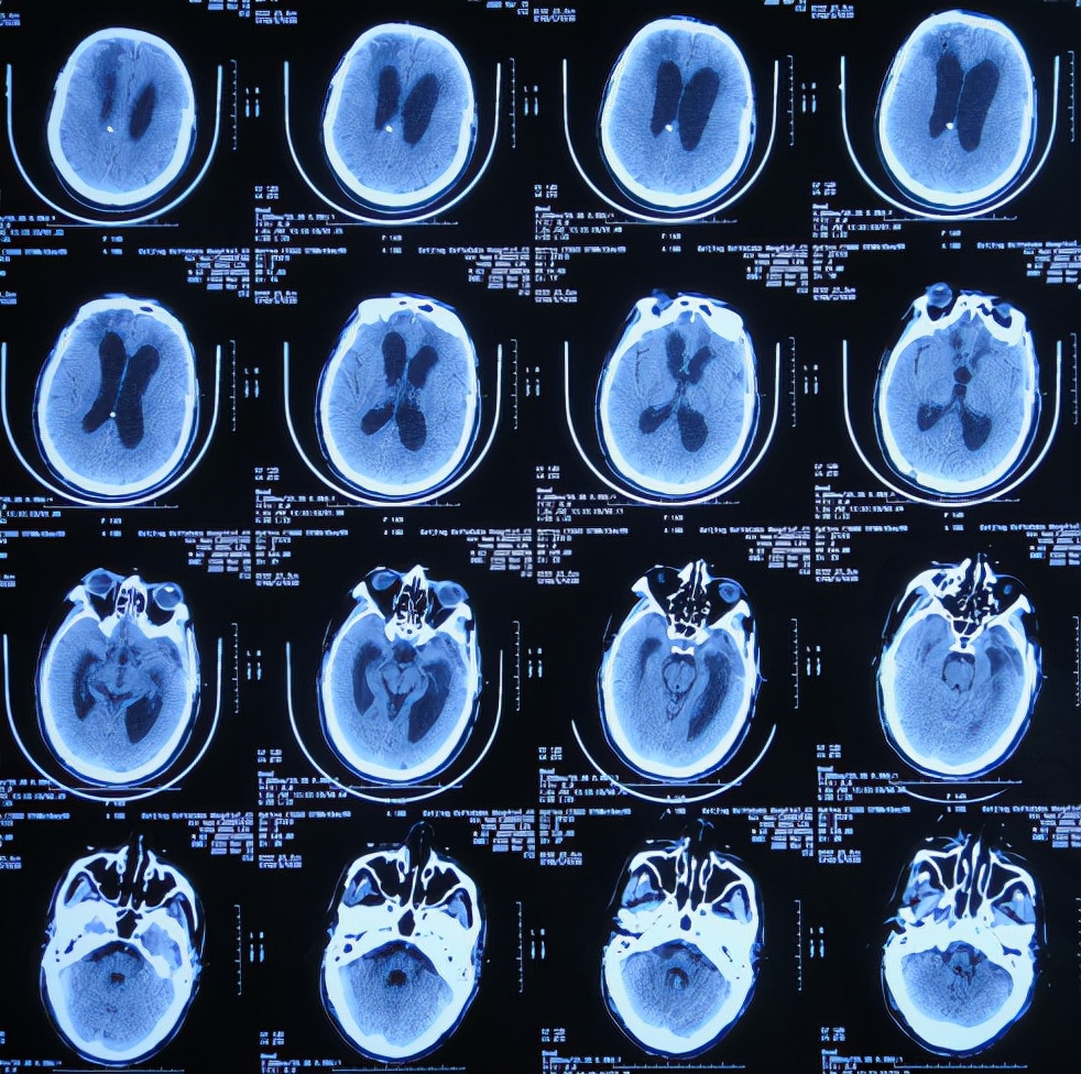 图-24:2020年1月22日头颅核磁图-25:2020年1月29日头颅ct图-26:2020年