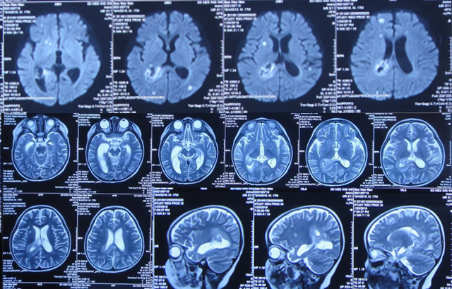 儿童化脓脑膜炎性脑积水,脑室外引流术和ommaya囊术后颅内感染致脑室