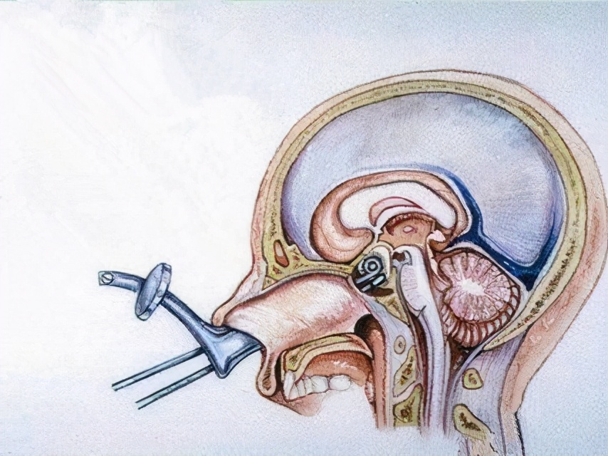 一文认识垂体瘤