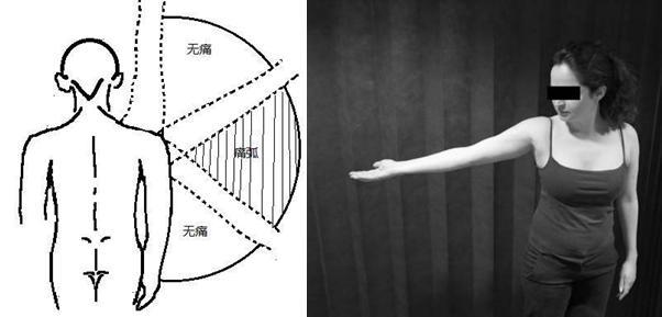 图 11 疼痛弧征检查示意图上文结合组成肩袖的四条肌肉的解剖及功能