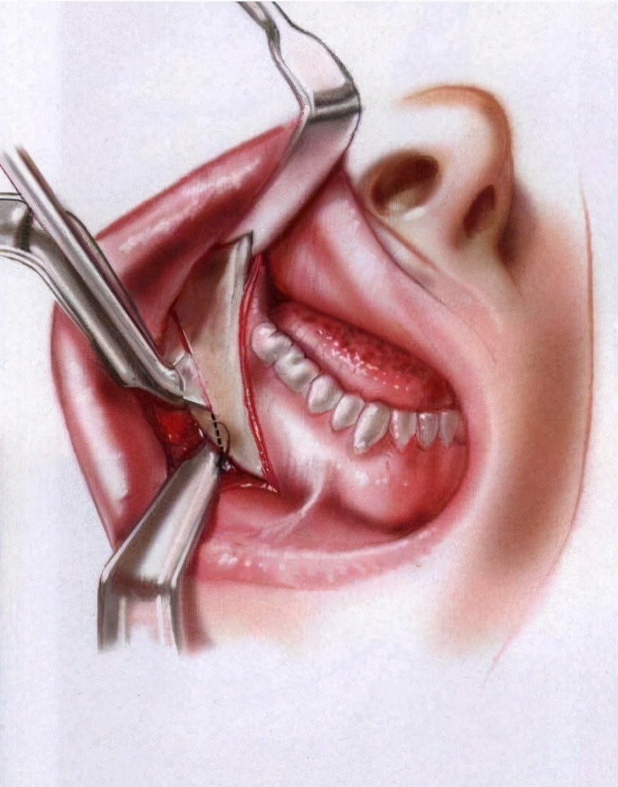 下颌角手术会留有 !--haodf:8:bahen-->瘢痕 !--haodf:/8:bahen-->吗?