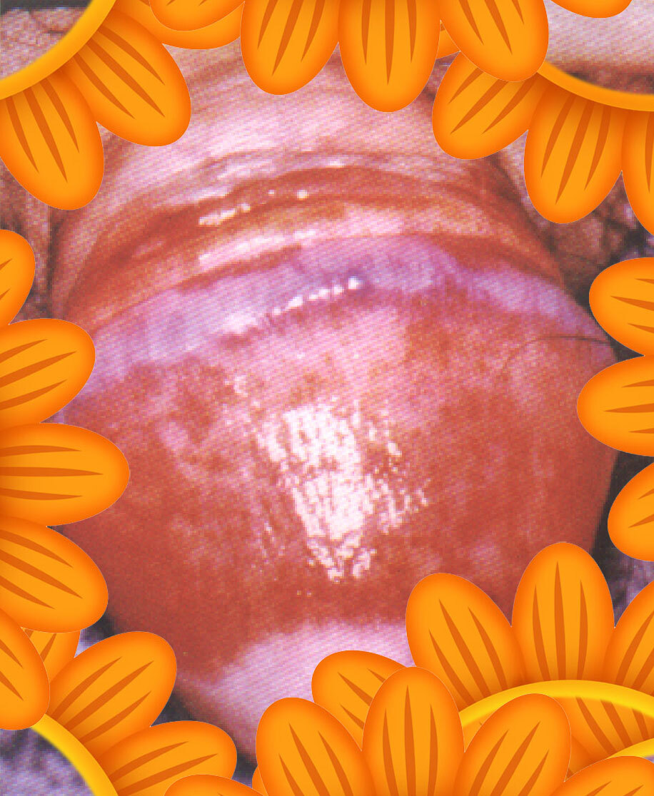 干燥性龟头炎症状图图片
