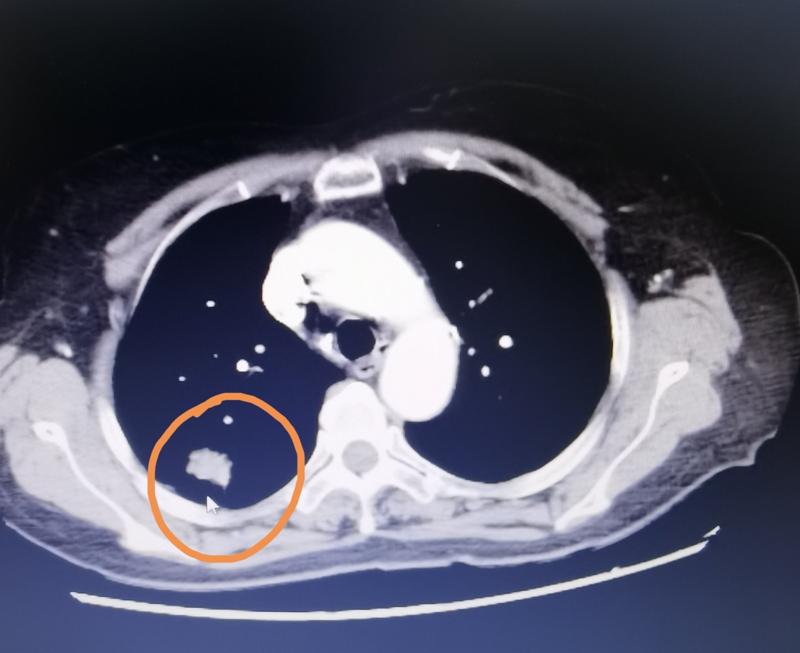 刘懿博士说肺癌(三五九三)结节牵拉胸膜预示肺癌可能侵犯胸膜了_肺癌