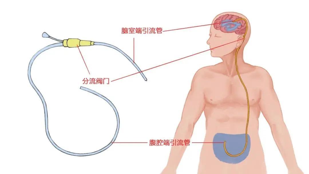 先天性脑积水患者这一路是怎么走过来的?