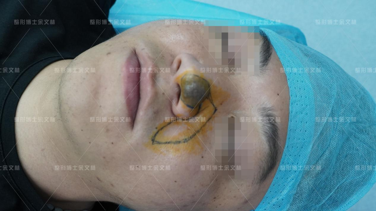 【案例分享】记录去除鼻头黑毛痣全过程 - 好大夫在线