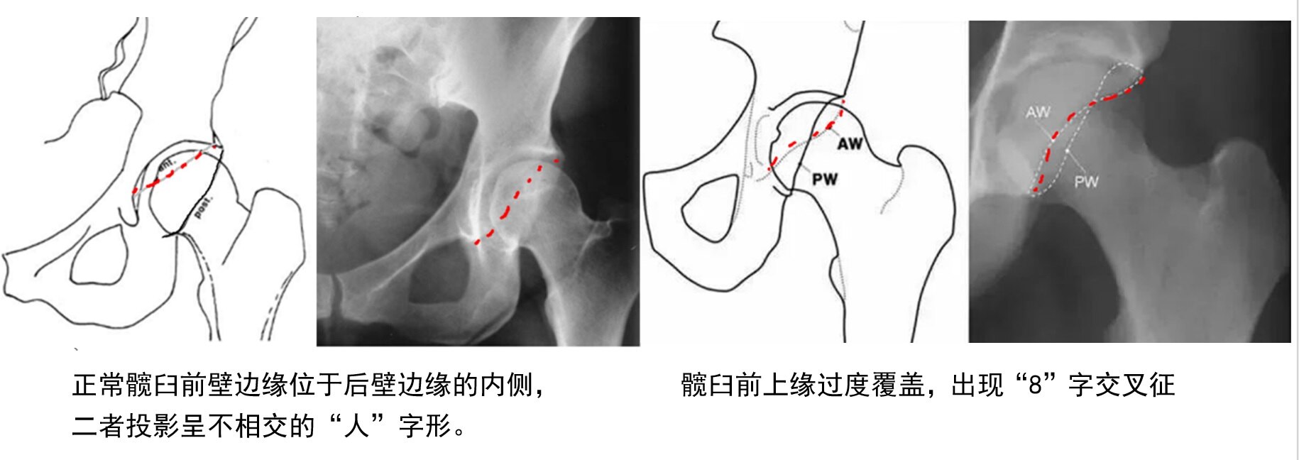 髋臼后倾.jpg