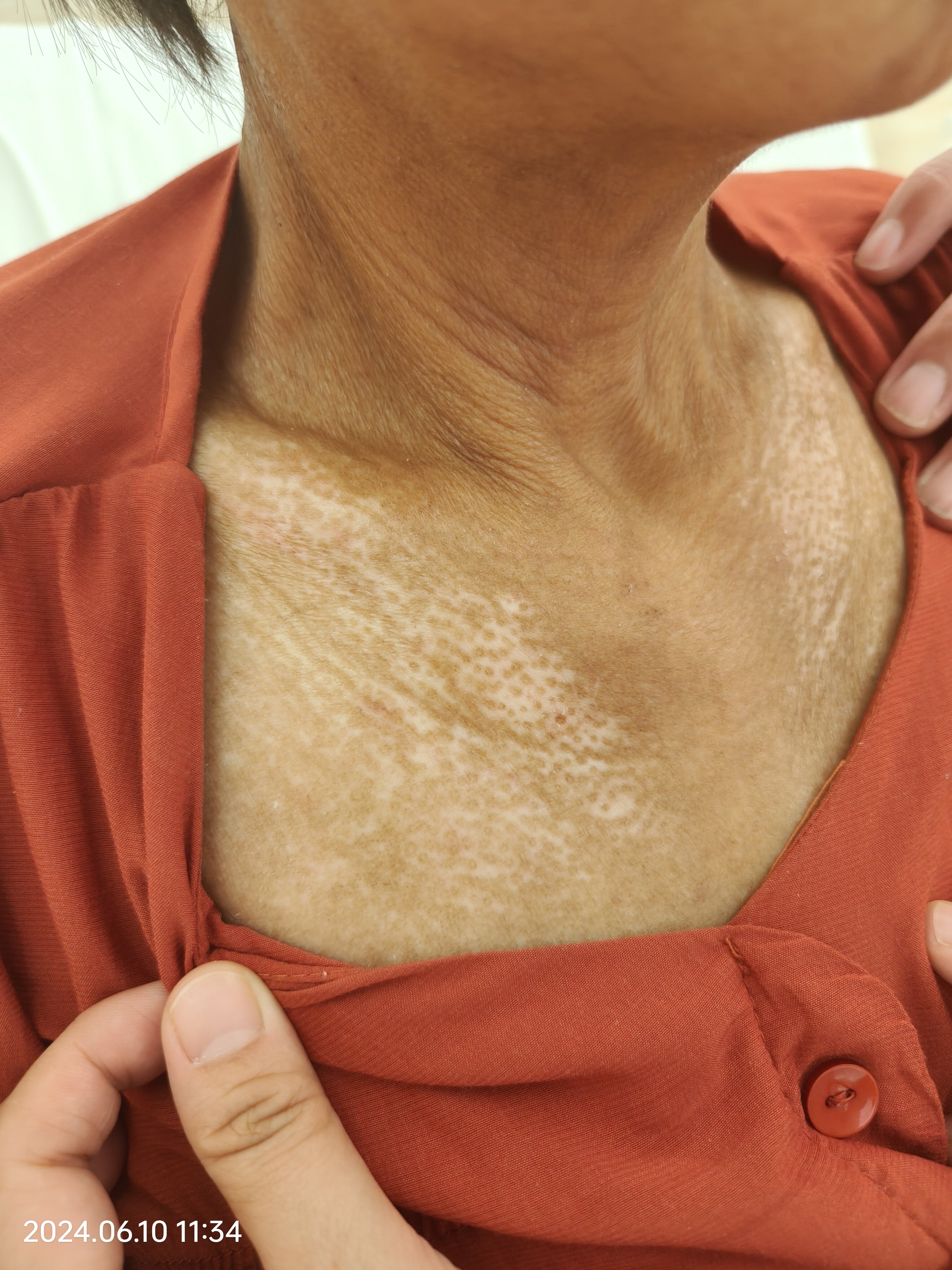 硬皮病焦盐征,皮肤硬化