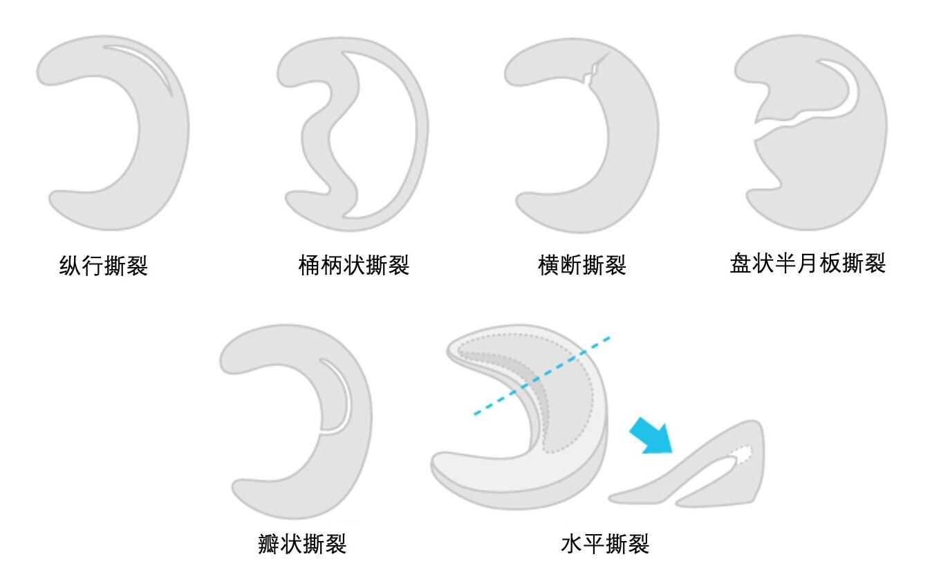 半月裂孔解剖图图片