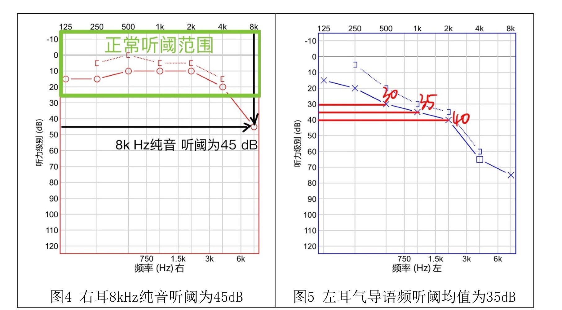 两个步骤教你看懂听力报告_耳疾病_耳疾病相关疾病 - 好大夫在线