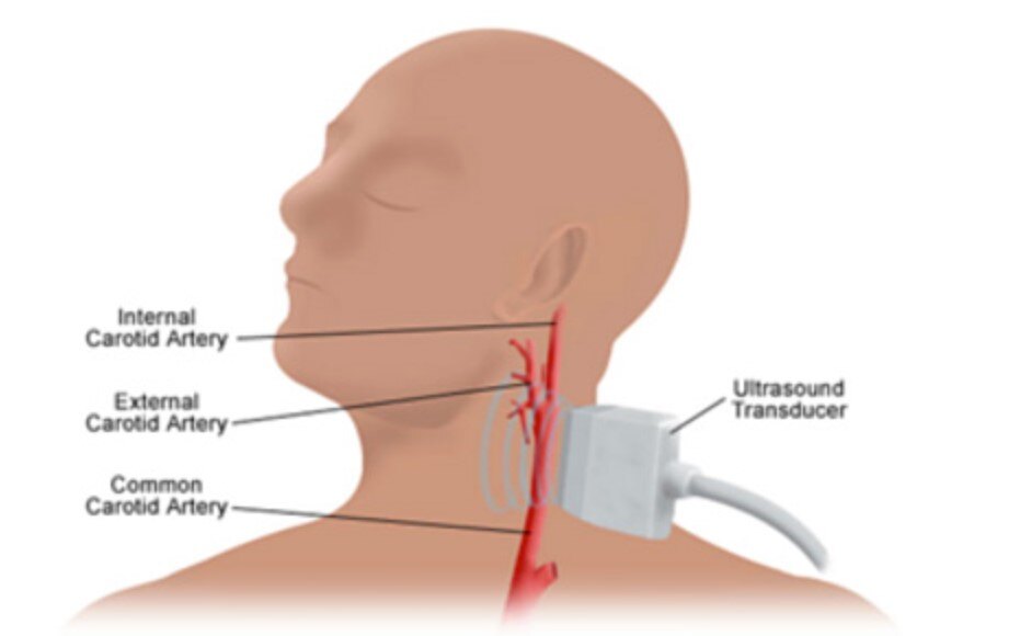 颈动脉B超.jpg