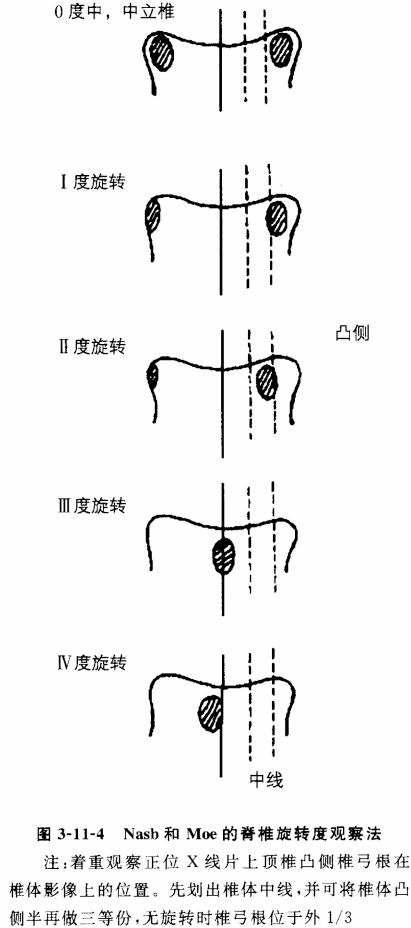 椎体旋转度?_脊柱侧弯_脊柱侧弯检查 - 好大夫在线