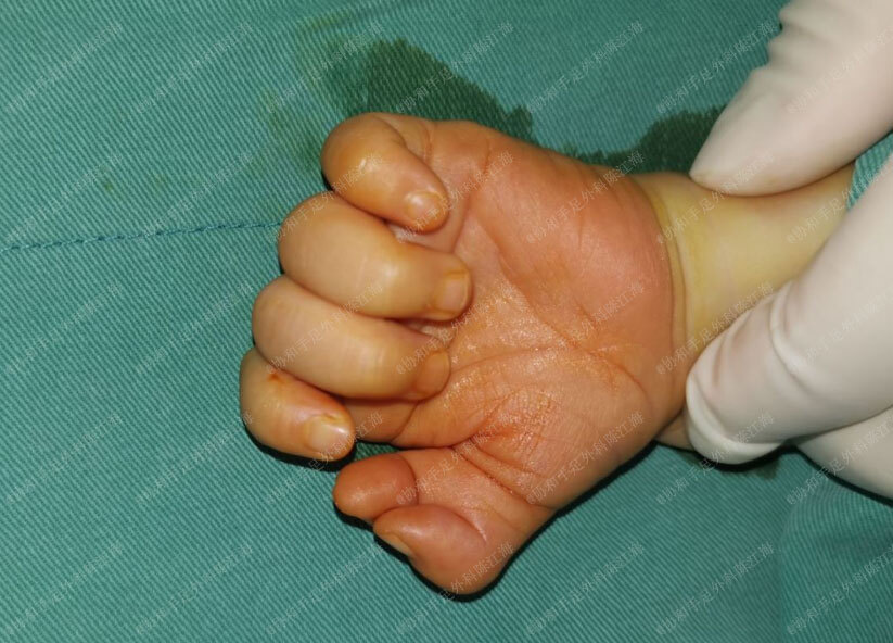 多指畸形哪家医院看的好,治疗多指畸形哪个医生好,多指畸形推荐医院