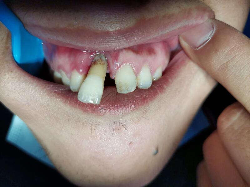牙齿致密性骨炎图片