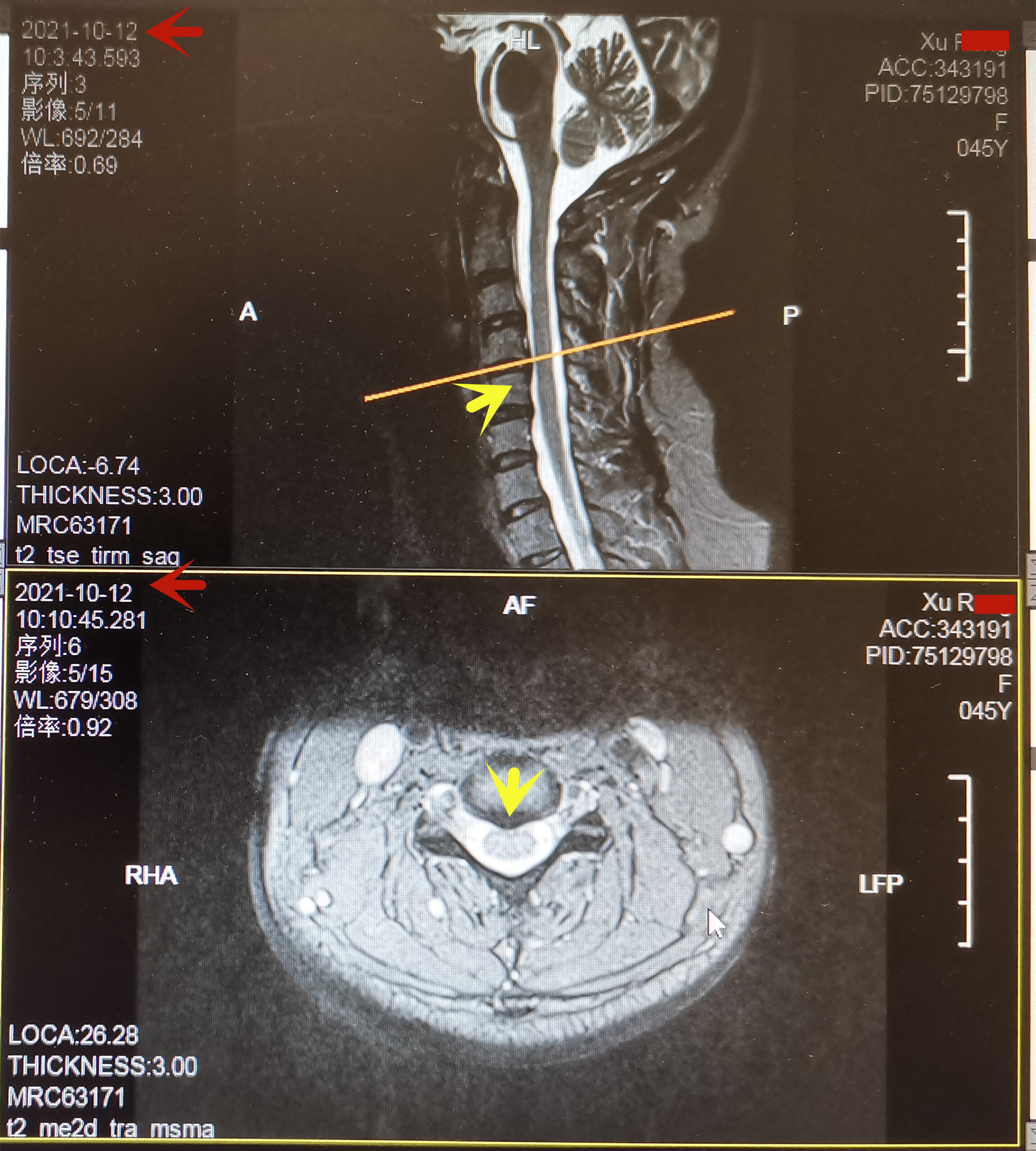 20211012徐蓉颈椎mri