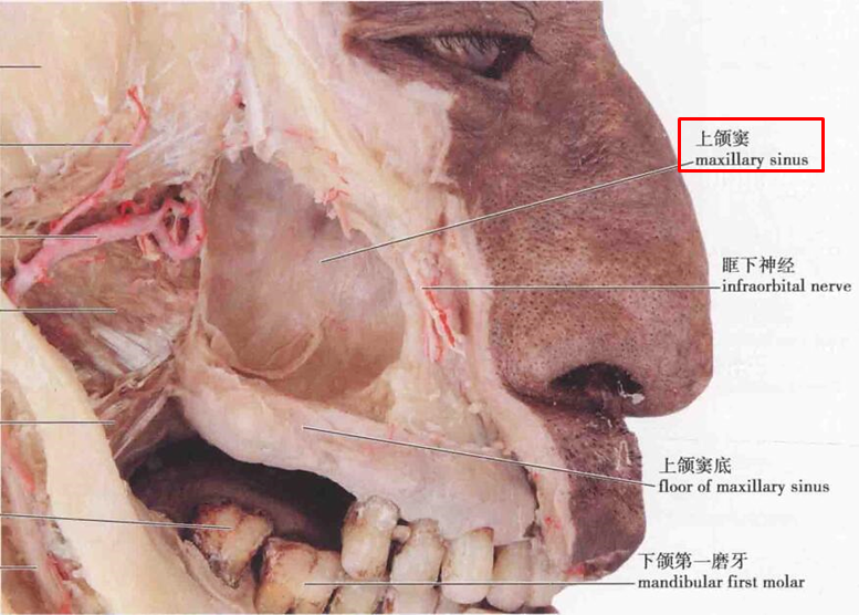 上颌窦裂孔图片