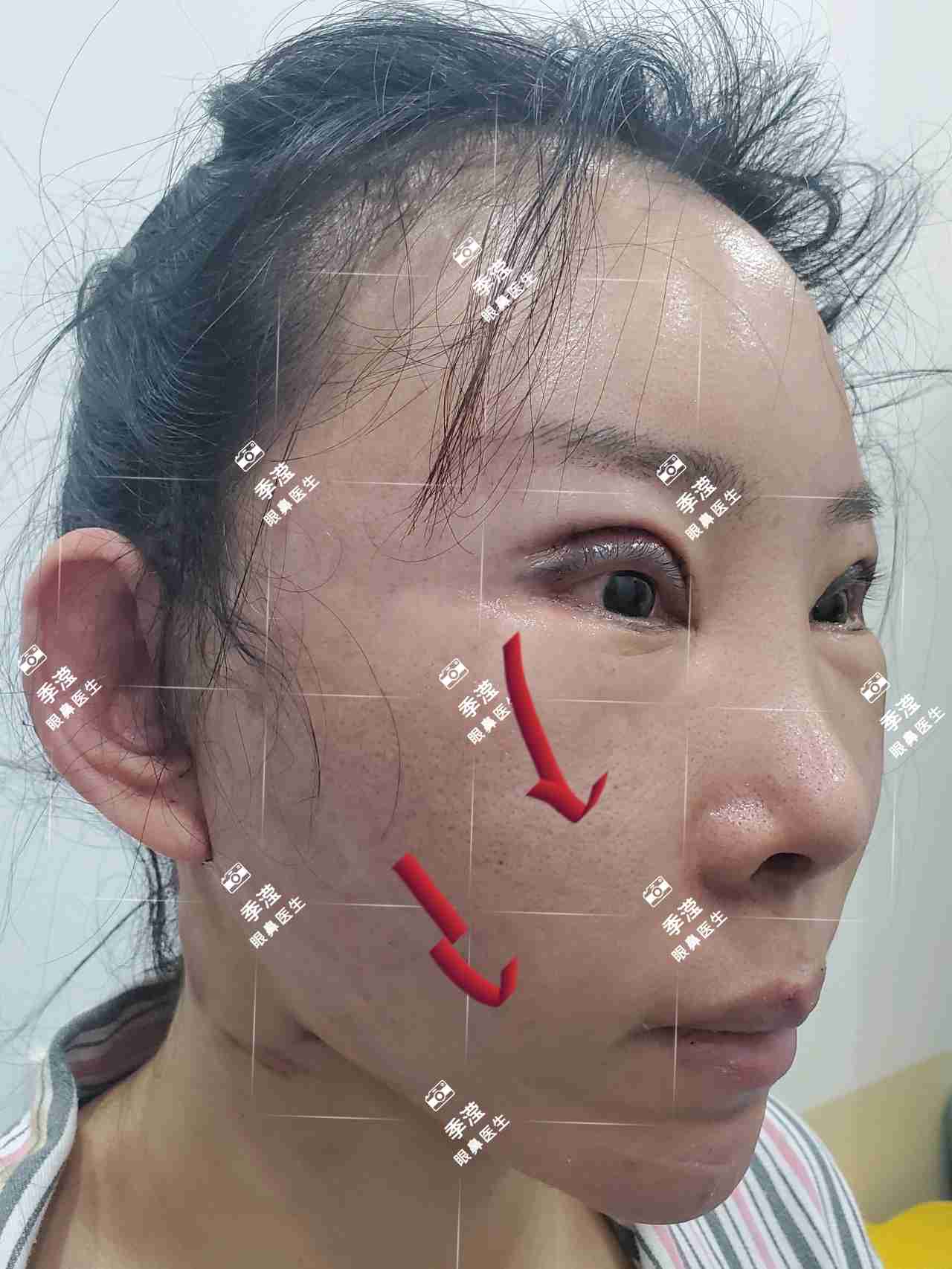 面部提升（拉皮）的抗衰效果怎么样？哪些医生擅长面部拉皮手术？ - 知乎