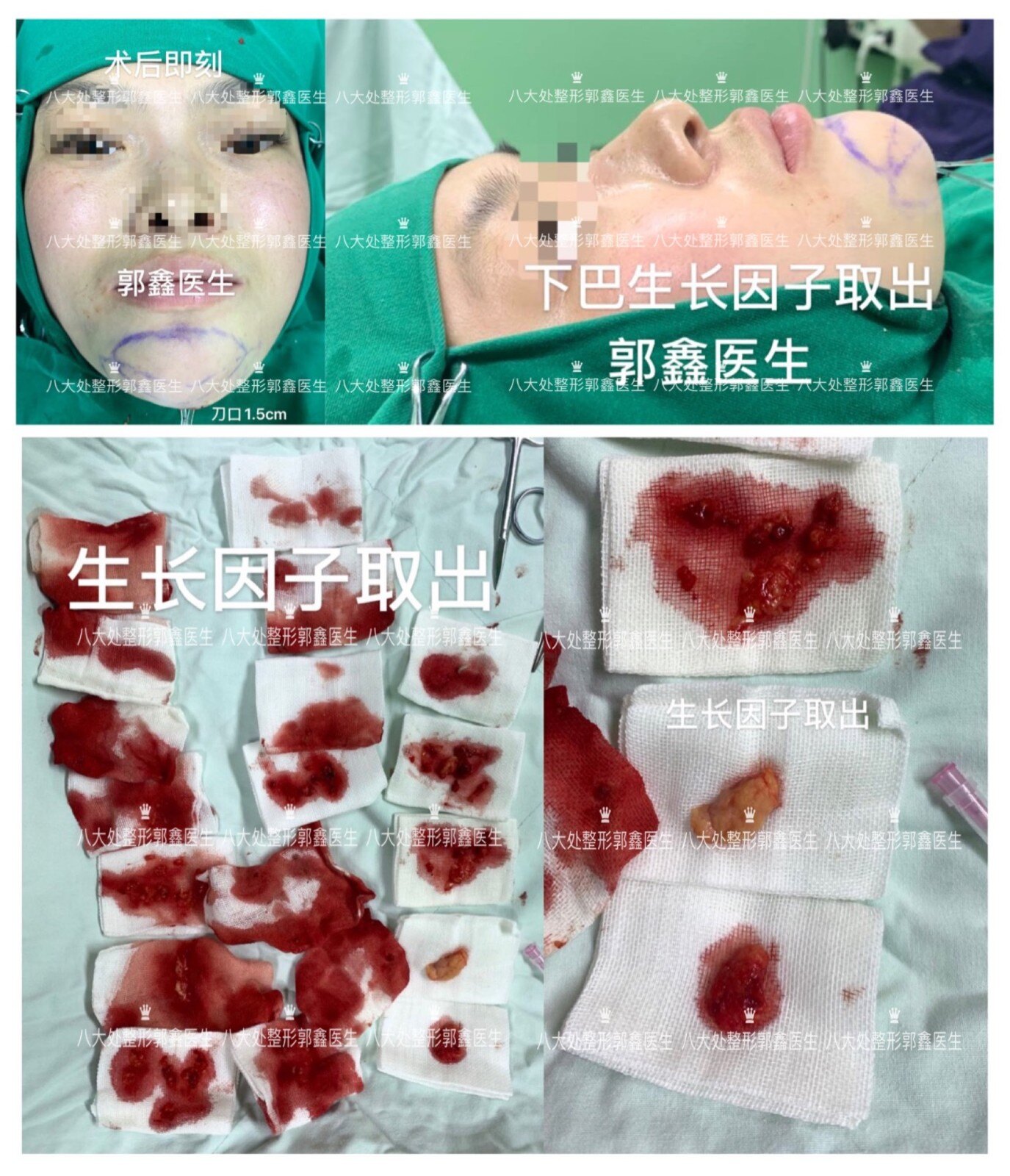 生长因子,童颜针,脂肪填充修复案例和简介(郭鑫医生)