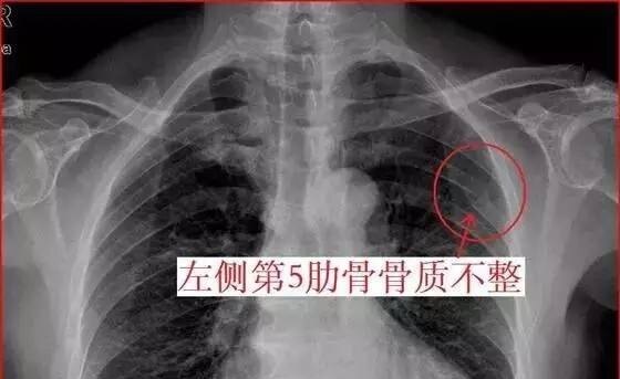 隐匿性肋骨骨折 肋骨骨折 隐匿性肋骨骨折 肋骨骨折