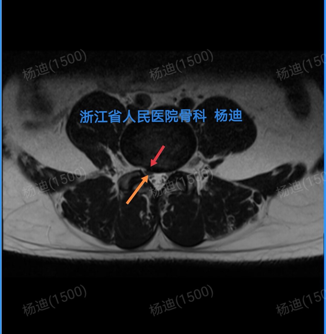 腰椎磁共振腰4/5層面,紅色箭頭提示右側椎間盤突出,橙色箭頭提示右側