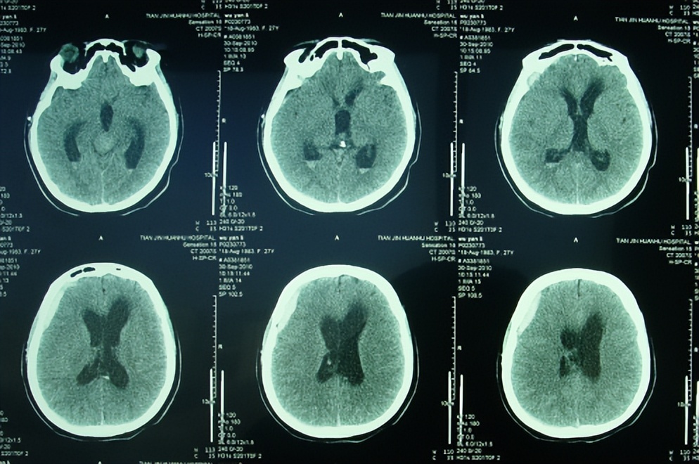 脑积水分流感染性致肢体震颤芭蕾舞足脑室镜第三脑室造瘘术和6次脑室