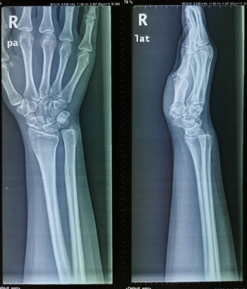 腕部下尺桡关节损伤 druj— 之一 临床表现