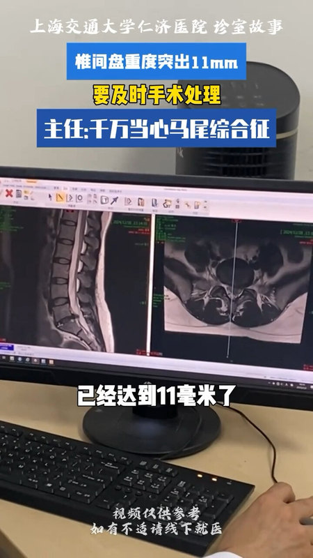 ＃椎间盘脱出