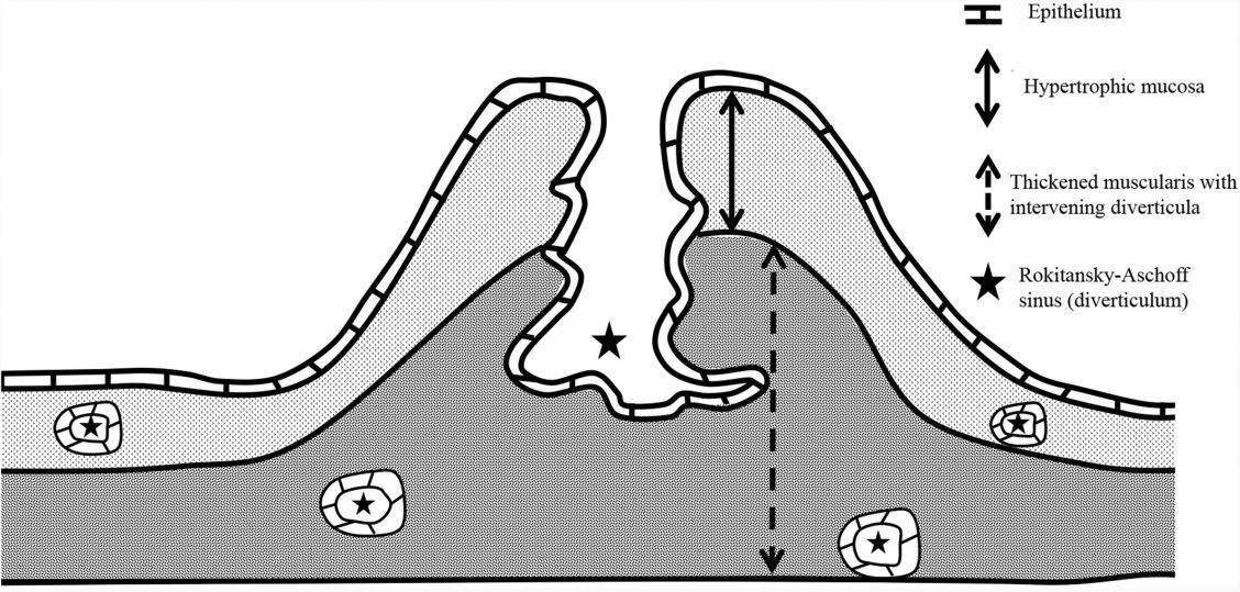 Figure 3. Pathological pattern of adenomyomatosis..jpg