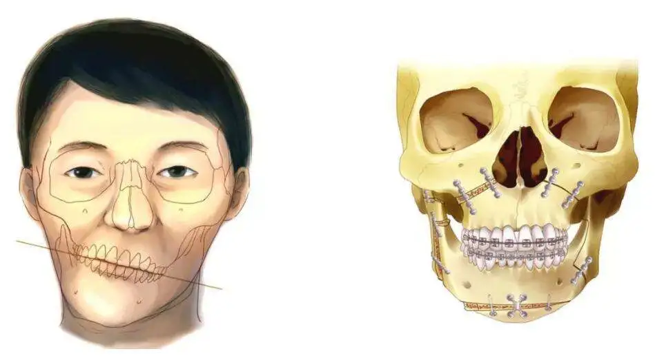 歪斜的臉型應該如何改善?