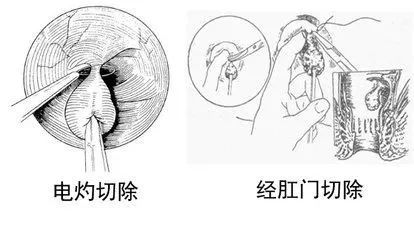 【科普】直肠息肉 - 好大夫在线