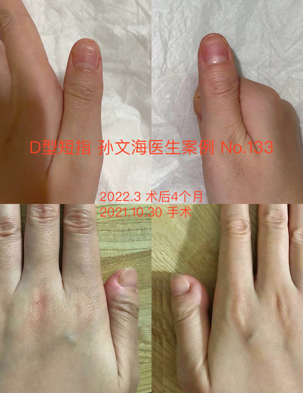 D型短指症的手术方法（附案例集）_短指症_短指症治疗方式 - 好大夫在线