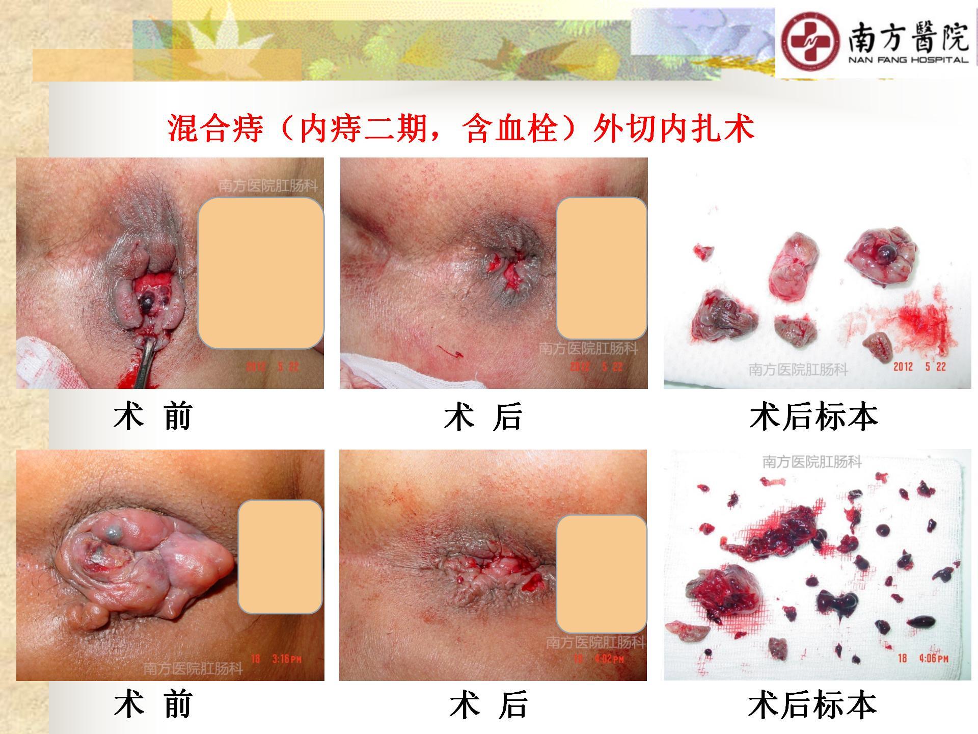 痔的精准化规范化微创化治疗之疼痛治疗_11.jpg